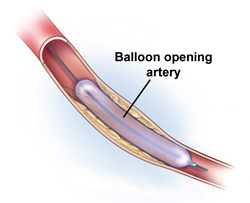 Arterial%20balloon%20angioplasty